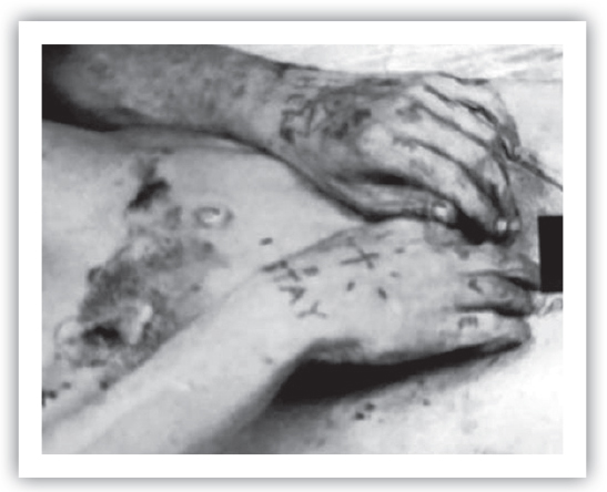 A photo of the mangled hands of Audrey Nelson. 
